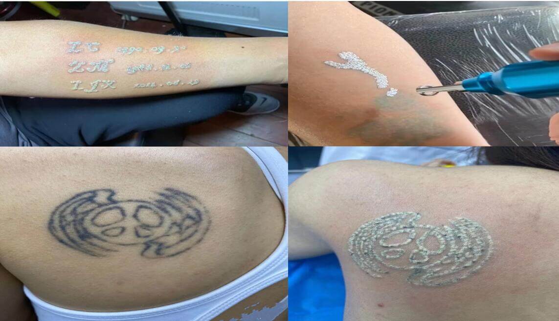 applications of laser tattoo removal machine