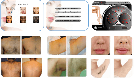 professional laser hair removal machines for sale