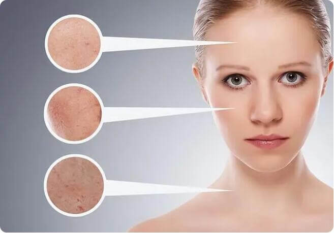 ablative fractional laser treatment