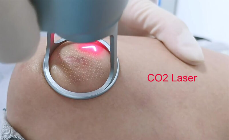 co2 fractional laser machine for sale-2