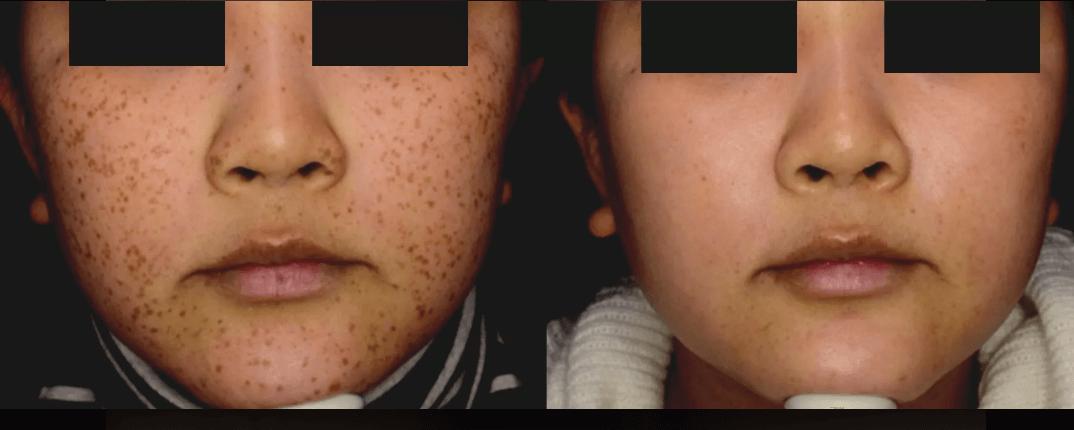 picosure+freckles+before+and+after
