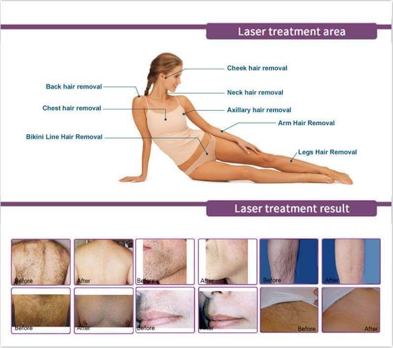 fda approved laser hair removal devices