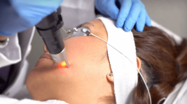 picosecond laser skin treatment