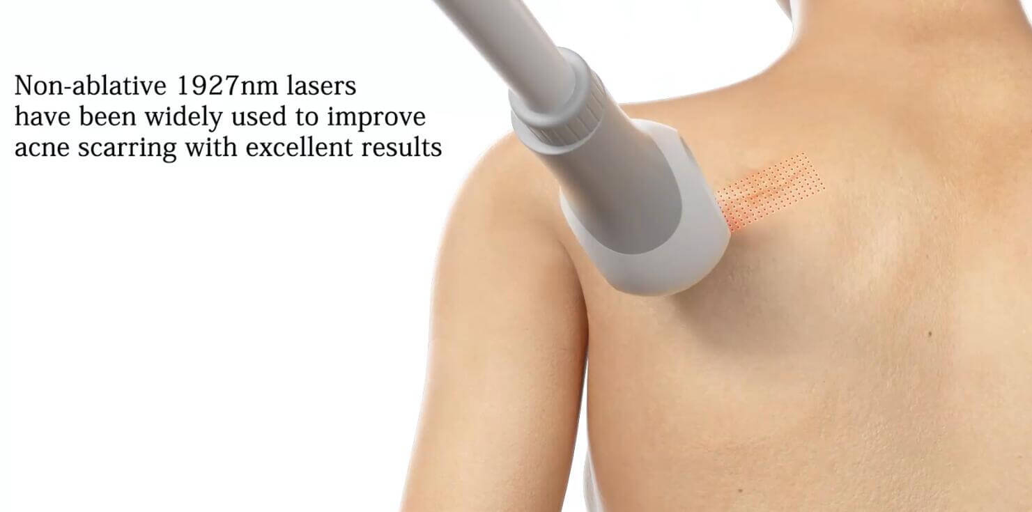 thulium laser machine-2