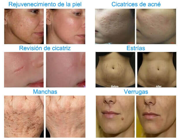 ablative fractional laser treatment