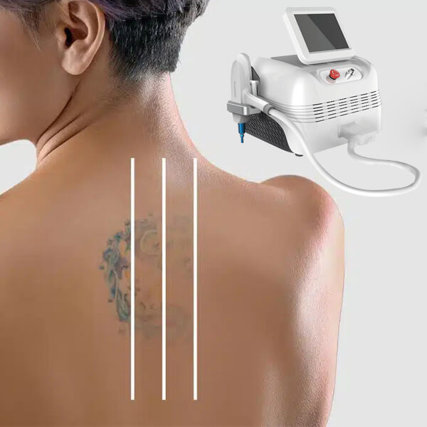 Q switched ND YAG laser tattoo removal machine for sale