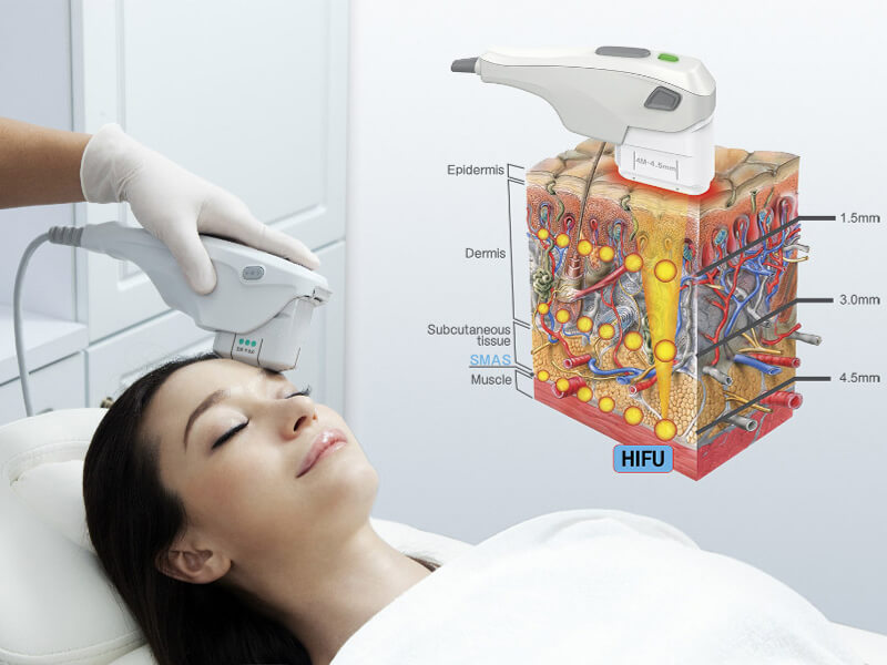 HIFU skin rejuvenation machine-2
