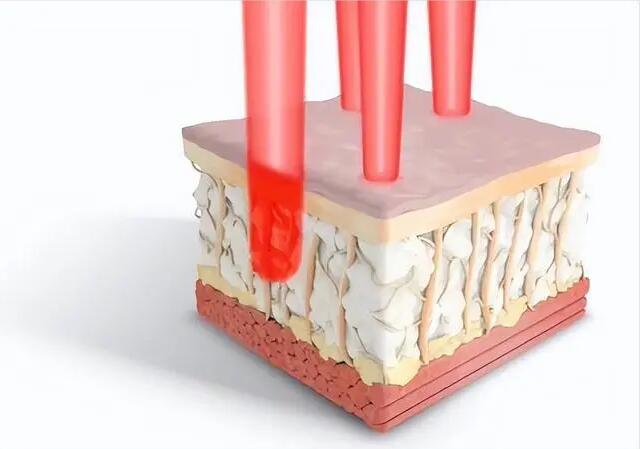 co2 fractional laser skin resurfacing treatment